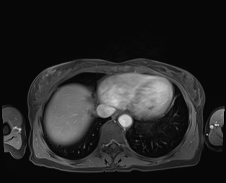Normal adrenal glands MRI (Radiopaedia 82017-96004 M 7).jpg
