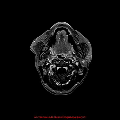 Normal adult brain MRI (non-enhanced and contrast-enhanced) (Radiopaedia 75262-86379 Axial T1 C+ 13).jpg