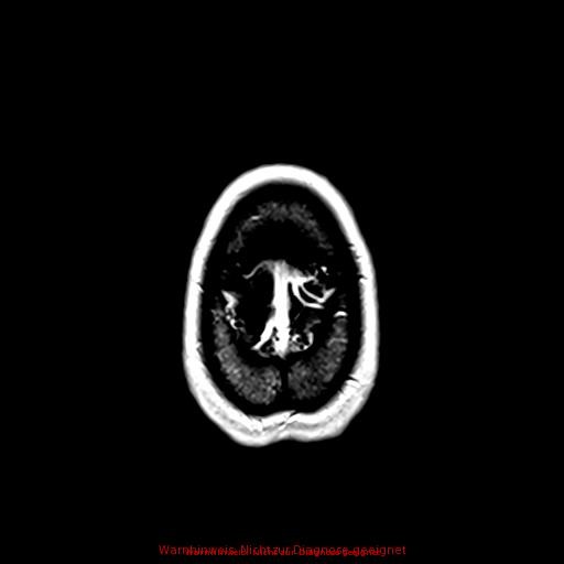 Normal adult brain MRI (non-enhanced and contrast-enhanced) (Radiopaedia 75262-86379 Axial T1 C+ 170).jpg