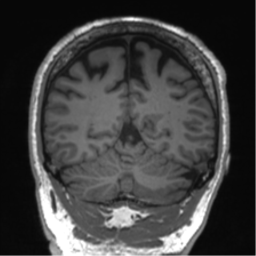 Normal brain MRI (non-focal epilepsy protocol) (Radiopaedia 53917-60040 Coronal T1 21).png