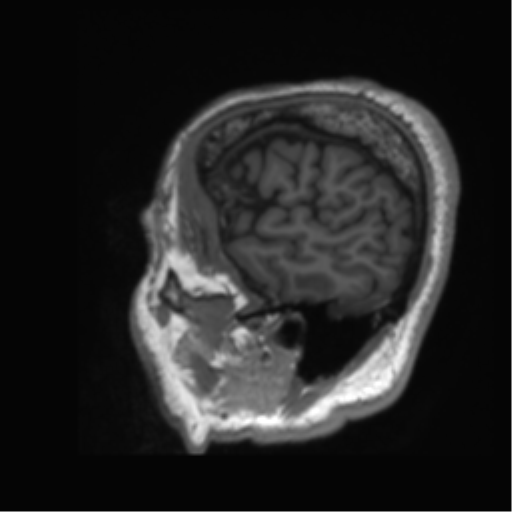 Normal brain MRI (non-focal epilepsy protocol) (Radiopaedia 53917-60040 Sagittal T1 3).png