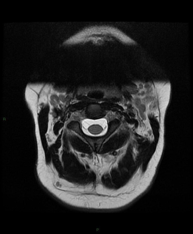 Normal cervical spine MRI (Radiopaedia 80146-93454 Axial T2 10).jpg