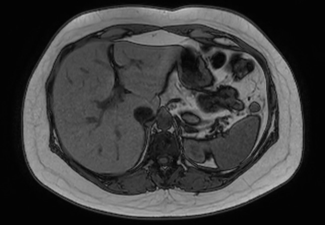 File:Normal liver MRI with Gadolinium (Radiopaedia 58913-66163 B 22).jpg