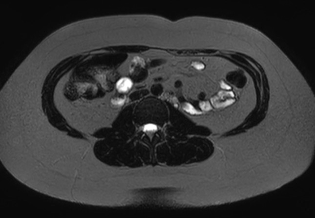 File:Normal liver MRI with Gadolinium (Radiopaedia 58913-66163 E 4).jpg