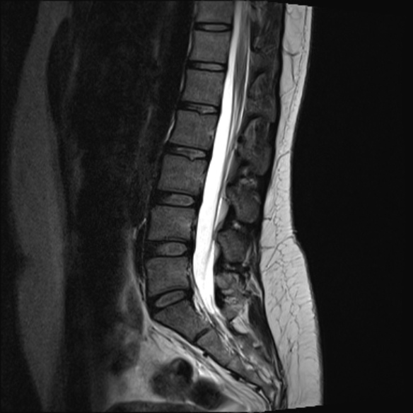 File:Normal lumbar spine MRI- 3 T (Radiopaedia 53280-59250 Sagittal T2 14).jpg