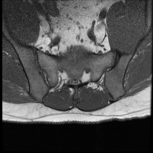 File:Normal lumbar spine MRI (Radiopaedia 35543-37039 Axial T1 2).png