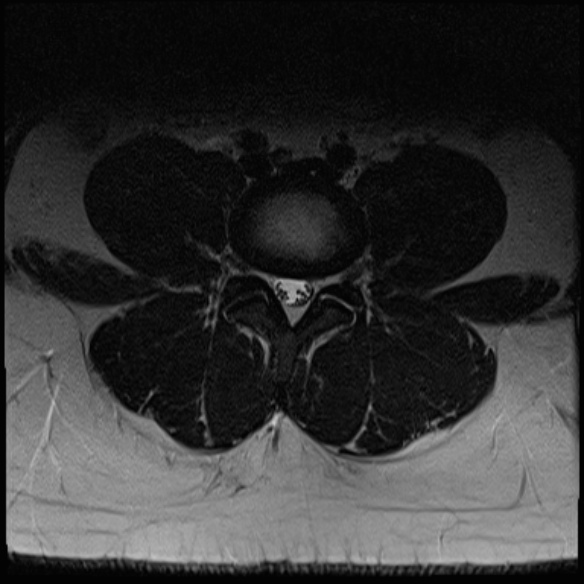 File:Normal lumbar spine MRI (Radiopaedia 47857-52609 Axial T2 17).jpg