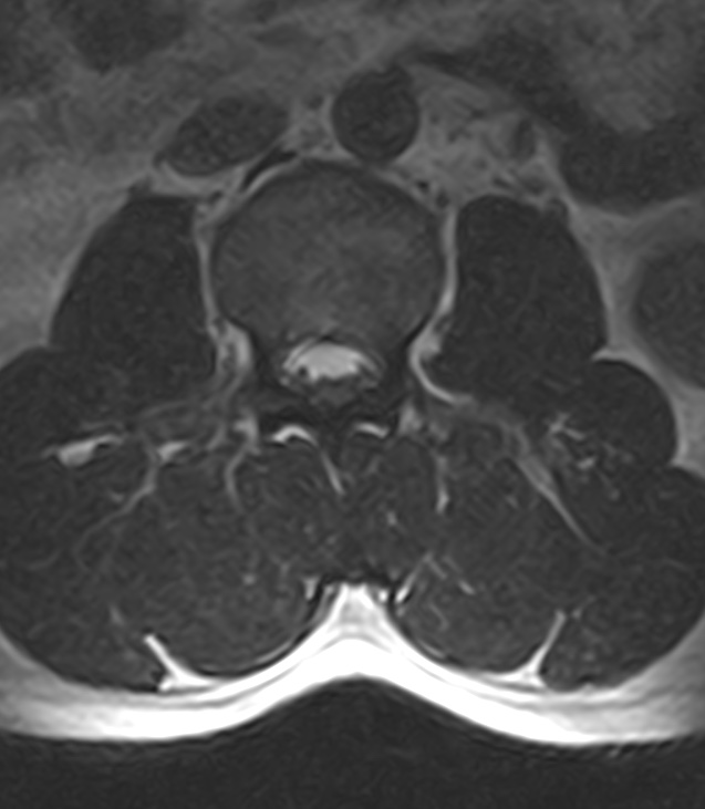 Normal lumbar spine MRI - low-field MRI scanner (Radiopaedia 40976-43699 Axial T2 41).jpg