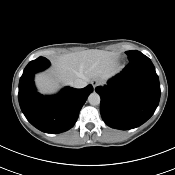 File:Normal multiphase CT liver (Radiopaedia 38026-39996 Axial C+ delayed 7).jpg