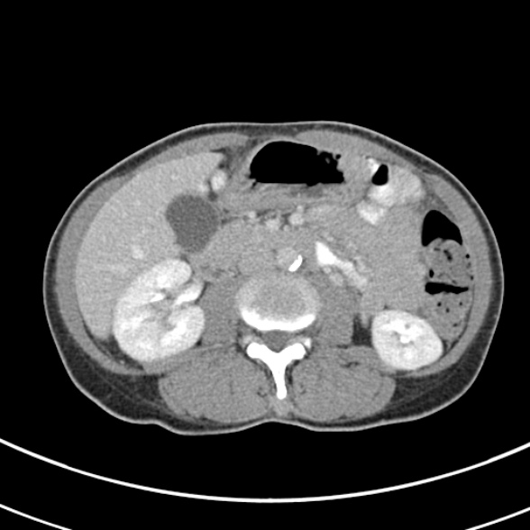 File:Normal multiphase CT liver (Radiopaedia 38026-39996 C 41).jpg
