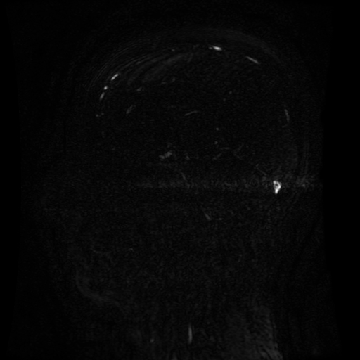 Normal noncontrast MR venography (Radiopaedia 87578-103957 A 75).jpg