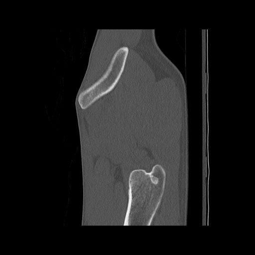 Normal pelvis (Radiopaedia 51473-57238 Sagittal bone window 17).jpg