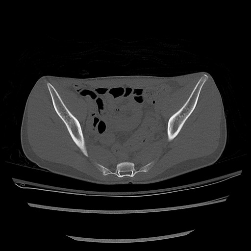 Normal pelvis CT (Radiopaedia 51471-57236 Axial bone window 47).jpg