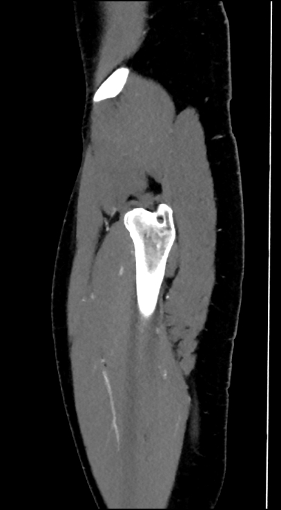 Normal pelvis CT angiogram (Radiopaedia 84966-100481 C 10).jpg