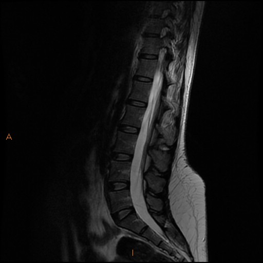 File:Normal spine MRI (Radiopaedia 77323-89408 Sagittal T2 8).jpg