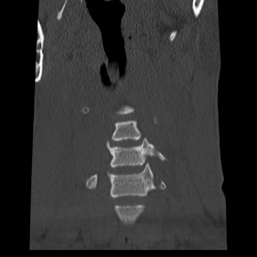 File:Normal trauma cervical spine (Radiopaedia 41017-43760 Coronal bone window 6).png