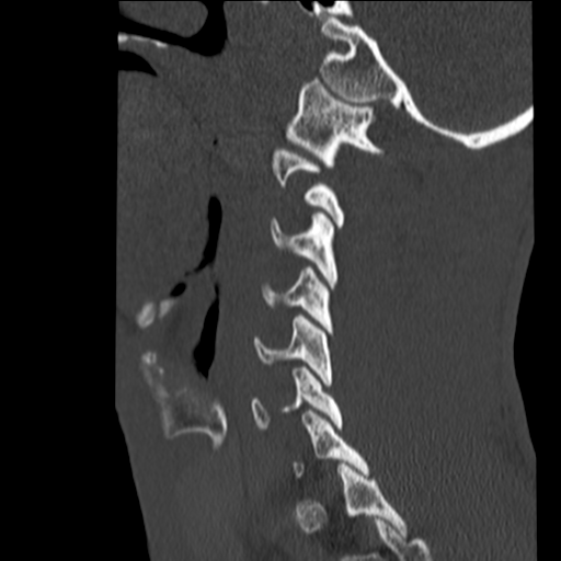 File:Normal trauma cervical spine (Radiopaedia 41017-43760 Sagittal bone window 9).png