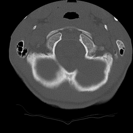 File:Normal trauma spine imaging (age 16) (Radiopaedia 45335-49358 Axial bone window 5).jpg