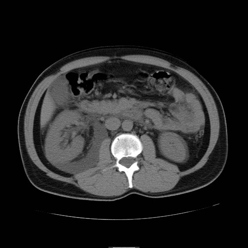 File:Obstructed kidney with perinephric urinoma (Radiopaedia 26889-27066 Axial non-contrast 23).jpg