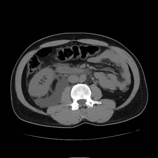 File:Obstructed kidney with perinephric urinoma (Radiopaedia 26889-27066 Axial non-contrast 27).jpg