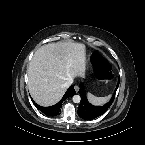 Obstructing sigmoid adenocarcinoma (Radiopaedia 58465-65619 A 27).jpg