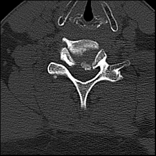 Occipital condyle fracture (type 1) (Radiopaedia 87670-104084 Axial bone window 63).jpg