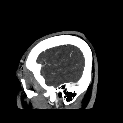 Occipital extradural hematoma simulating venous sinus thrombosis (Radiopaedia 46514-50964 D 11).jpg