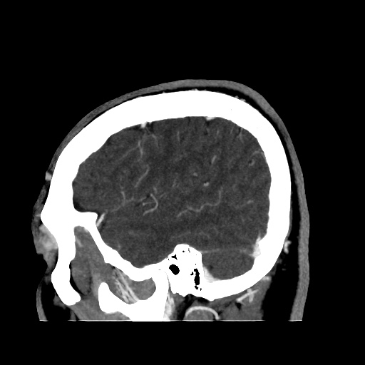 Occipital extradural hematoma simulating venous sinus thrombosis (Radiopaedia 46514-50964 D 16).jpg