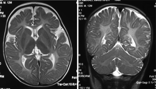 Left- MRI,abnormal high signal internal capsule,Right MRI,high signal white matter of cerebellum