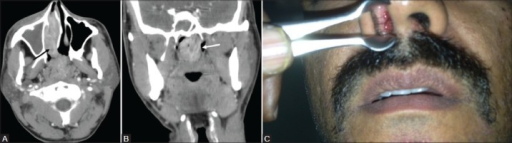 Contrast-enhanced CT PNS a) Axial image shows an enhancing soft tissue lesion (black arrow) in the right inferior nasal cavity extending through the choana into the nasopharynx. b) Coronal section shows lobulated nasopharyngeal extension of the lesion (white arrow) with prominent leash of blood vessels. c) Anterior rhinoscopy shows a red fleshy mass with whitish spots in the right nasal cavity. Diagnosis after surgery confirmed as rhinosporidiosis