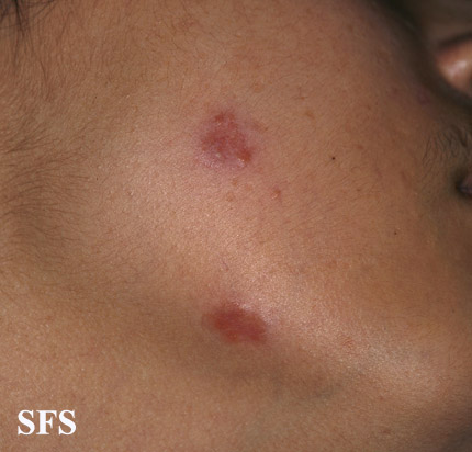 File:Sarcoidosis (Dermatology Atlas 28).jpg
