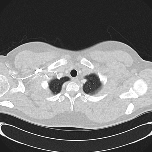 'Bovine' aortic arch (Radiopaedia 33554-34637 Axial lung window 7).png