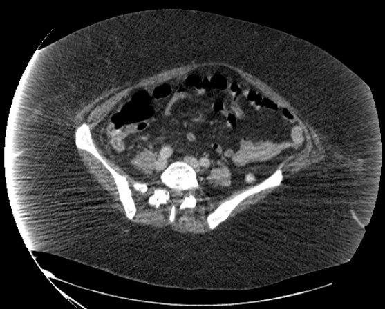File:Abdominal abscess - pre and post percutaneous drainage (Radiopaedia 60209-67816 Axial 62).png