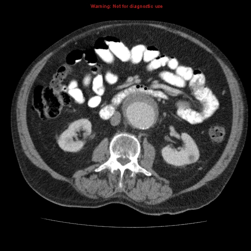 Abdominal aortic aneurysm (Radiopaedia 10122-10660 Axial C+ portal venous phase 36).jpg