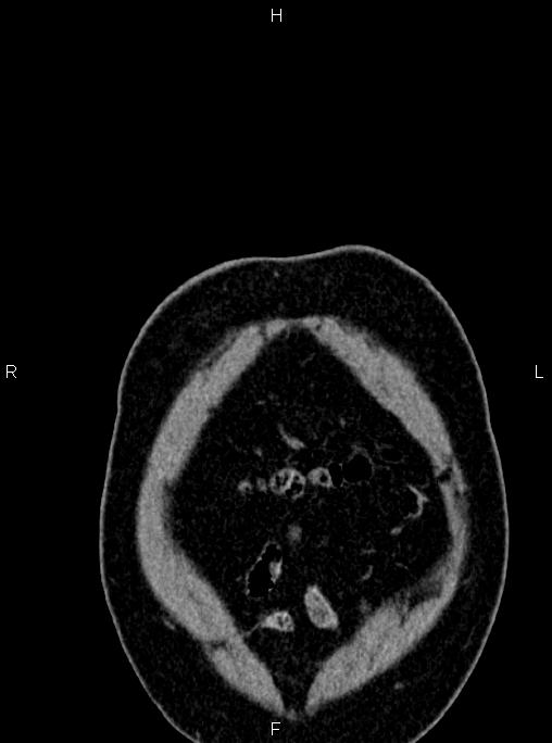 Abdominal aortic aneurysm (Radiopaedia 83094-97462 Coronal renal cortical phase 7).jpg