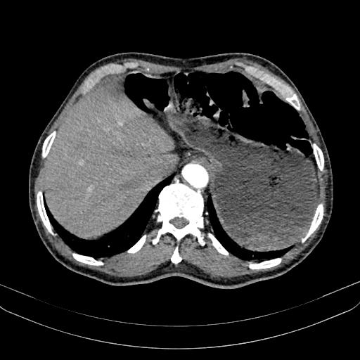 File:Abdominal aortic aneurysm (Radiopaedia 83581-98689 Axial C+ arterial phase 25).jpg