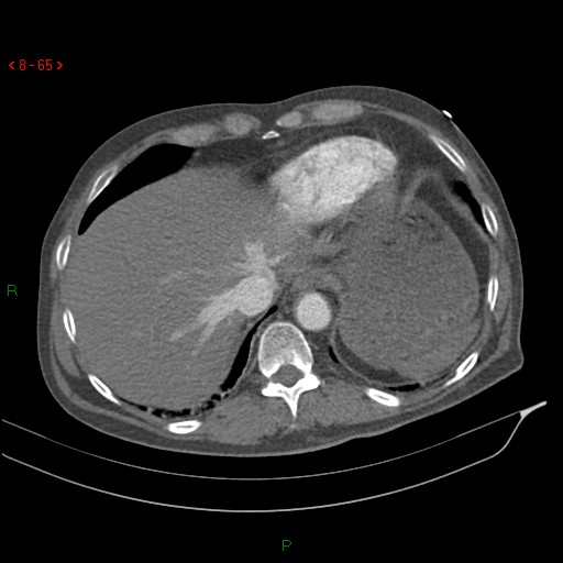 File:Abdominal aortic aneurysm rupture with aortocaval fistula (Radiopaedia 14897-14841 Axial C+ arterial phase 65).jpg