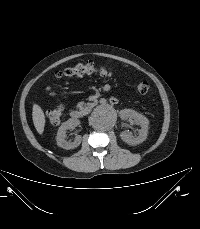 Abdominal aortic aneurysm with thrombus fissuration (Radiopaedia 46218-50618 Axial non-contrast 22).jpg