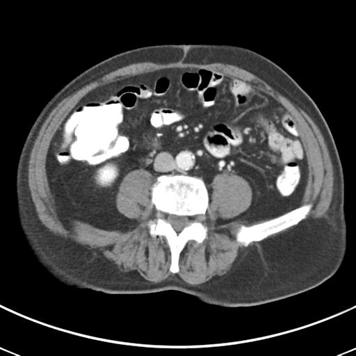 Abdominal wall metastasis from colorectal carcinoma (Radiopaedia 31016-31717 Axial C+ portal venous phase 44).jpg