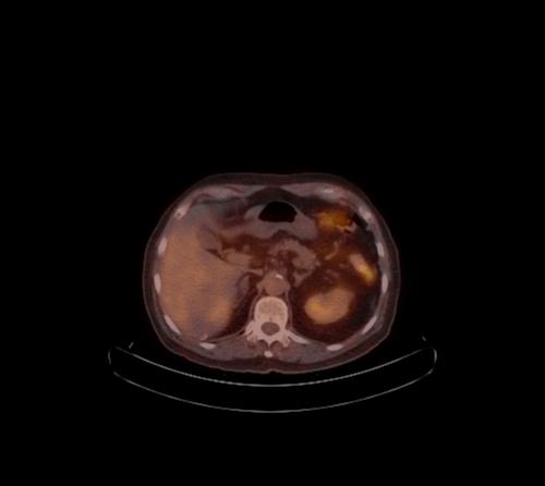 Abdominal wall metastasis from colorectal carcinoma (Radiopaedia 31016-31719 C 81).jpg