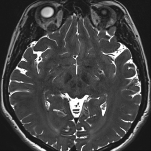 File:Abducens nerve palsy (Radiopaedia 51069-56648 Axial T2 fat sat 81).png