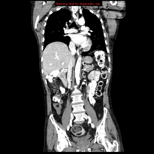 File:Aberrant right subclavian artery (Radiopaedia 9379-10071 Coronal C+ arterial phase 13).jpg