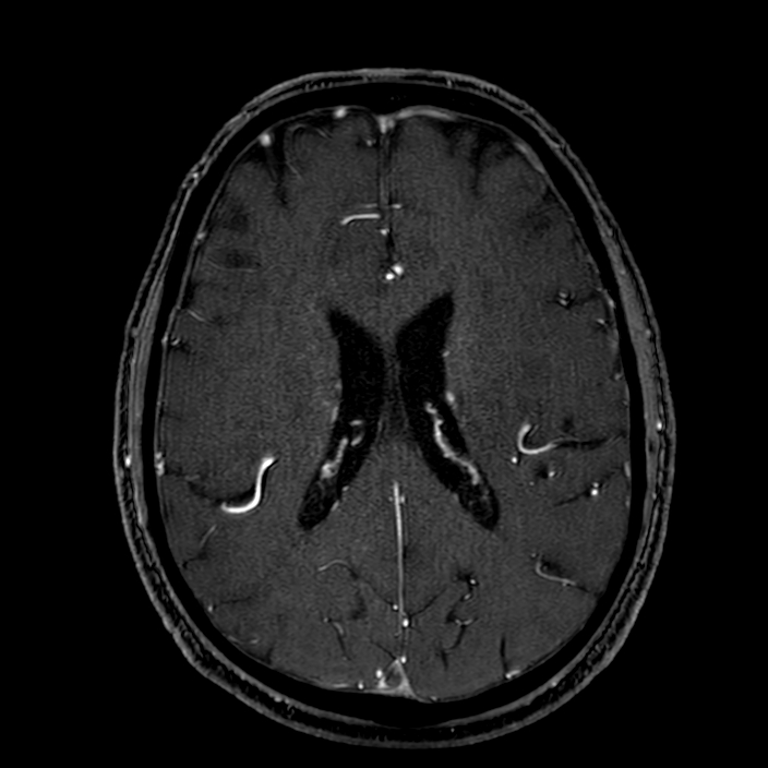 Accessory middle cerebral artery (Radiopaedia 73114-83828 Axial MRA 132).jpg