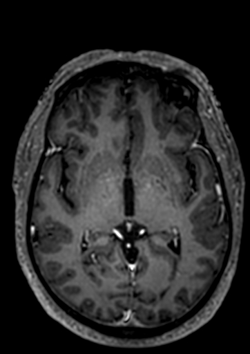 Accessory middle cerebral artery (Radiopaedia 73114-83828 Axial T1 C+ 44).jpg