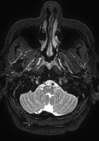 Accessory middle cerebral artery (Radiopaedia 73114-83828 Axial T2 205).jpg