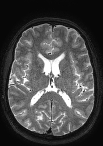 Accessory middle cerebral artery (Radiopaedia 73114-83828 Axial T2 48).jpg