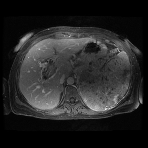 Acinar cell carcinoma of the pancreas (Radiopaedia 75442-86668 Axial T1 C+ fat sat 96).jpg