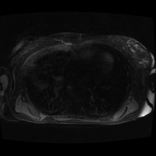 Acinar cell carcinoma of the pancreas (Radiopaedia 75442-86668 Axial late phase (~30 mins) 156).jpg