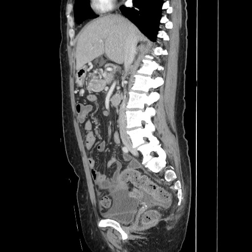 Acinar cell carcinoma of the pancreas (Radiopaedia 75442-86669 Sagittal C+ portal venous phase 88).jpg