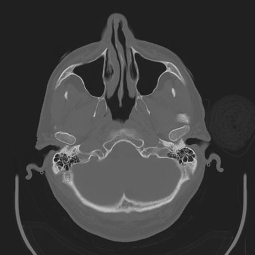 File:Acoustic schwannoma (Radiopaedia 29488-29982 AXIAL BONE THICK non-contrast 7).jpg